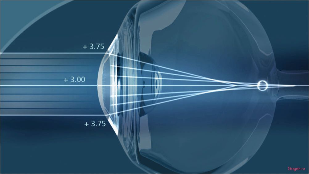 ReLEx SMILE: инновационный метод лазерной коррекции зрения безболезненно и безопасно