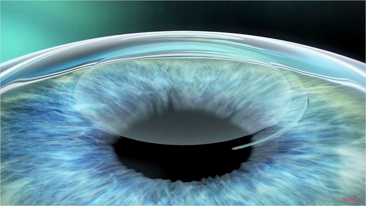 ReLEx SMILE: инновационный метод лазерной коррекции зрения безболезненно и безопасно