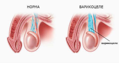 (варикоцеле, Варикоцеле