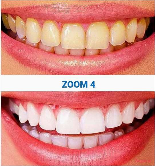 Отбеливание зубов zoom: эффективные методы и процедуры