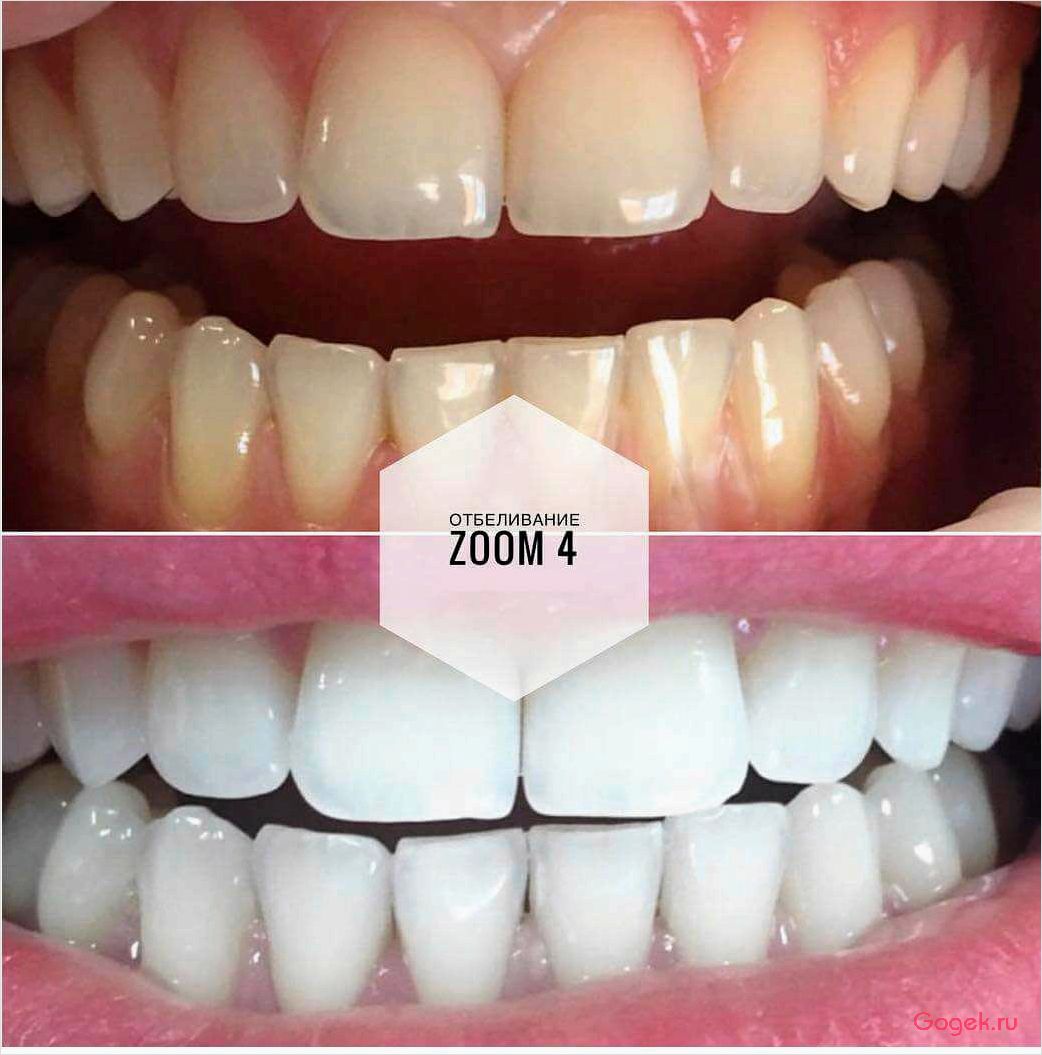 Отбеливание зубов zoom: эффективные методы и процедуры