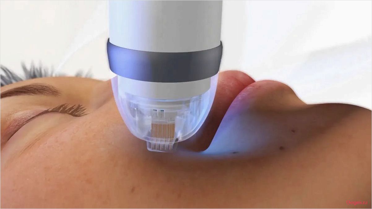 Микроигольчатый RF — новейшая технология омоложения кожи